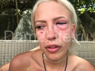 Кровавая бойня: Оля Сударкина сломала глазную орбиту Наташе Игруновой