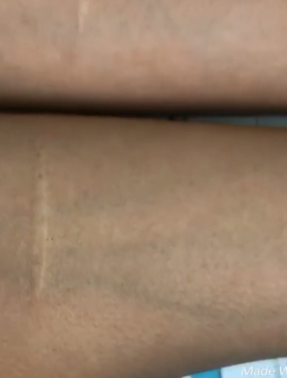 Либерж показала рубцы, оставшиеся на ее руках после ножевых ранений ​Фото: «Инстаграм»  