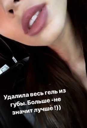 Настя Костенко уменьшила губы ​Фото:&nbsp; 