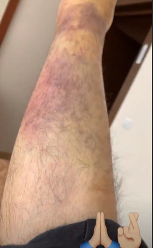 Дима Билан показал, как выглядит его сломанная нога Фото: «Инстаграм»  