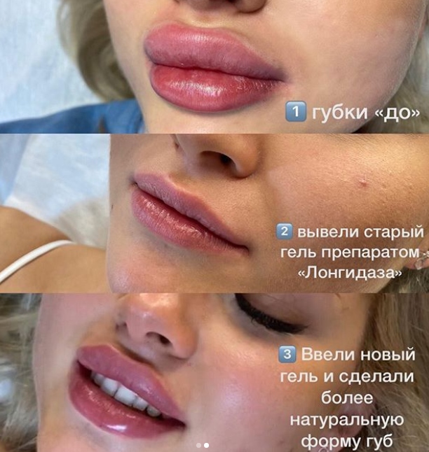6 российских звезд, которые зря увеличили губы